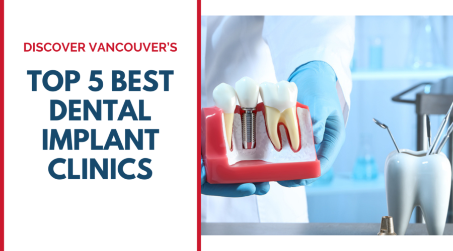 Discover Vancouver’s Top 5 Best Dental Implant Clinics